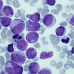 Cellule canaglia: stroncarle prima che si sviluppi la leucemia