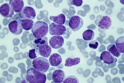 Leucemia mieloide acuta 