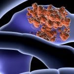 Mmri62: la molecola che uccide le cellule tumorali del pancreas