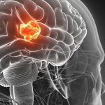 Nanotubi di dna: nuova speranza per il glioblastoma %nanotubi di dna: nuova speranza per il glioblastomacount(title)% Nanotubi di dna: nuova speranza per il glioblastoma