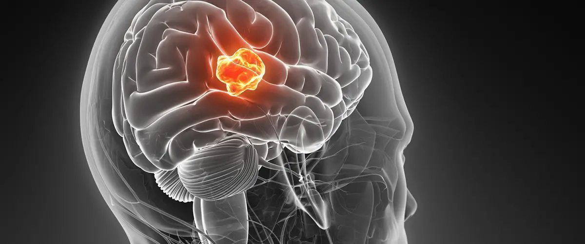 Nanotubi di dna: nuova speranza per il glioblastoma