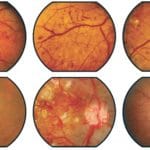 Retinopatia diabetica in aumento nei bambini con diabete t2 %retinopatia diabetica in aumento nei bambini con diabete t2 count(title)% Retinopatia diabetica in aumento nei bambini con diabete t2