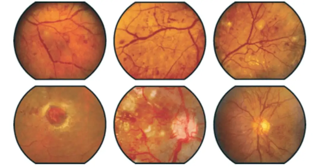 Retinopatia diabetica in aumento nei bambini con diabete t2 