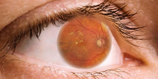 Retinopatia diabetica, glaucoma