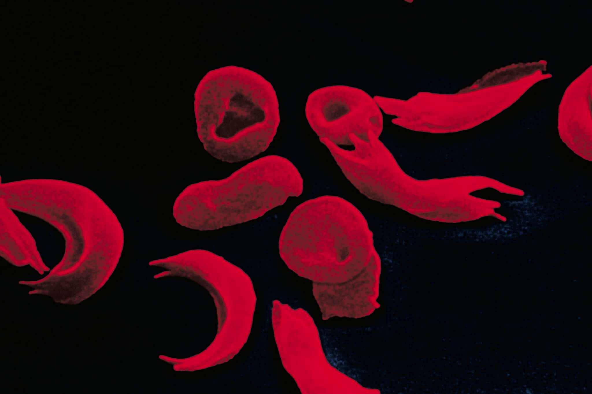 anemia falciforme