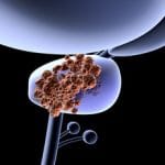 Carcinoma prostatico metastatico: combo di 3 farmaci prolunga la vita