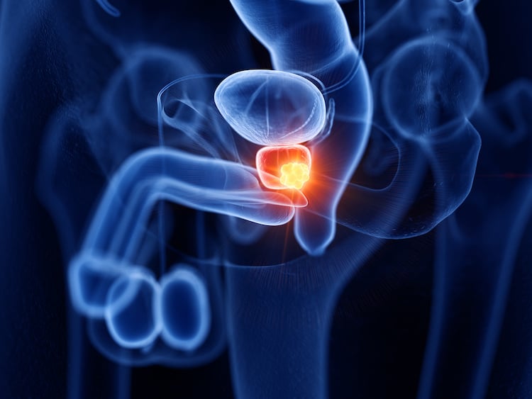 Carcinoma prostatico metastatico, metastasi del cancro alla prostata 