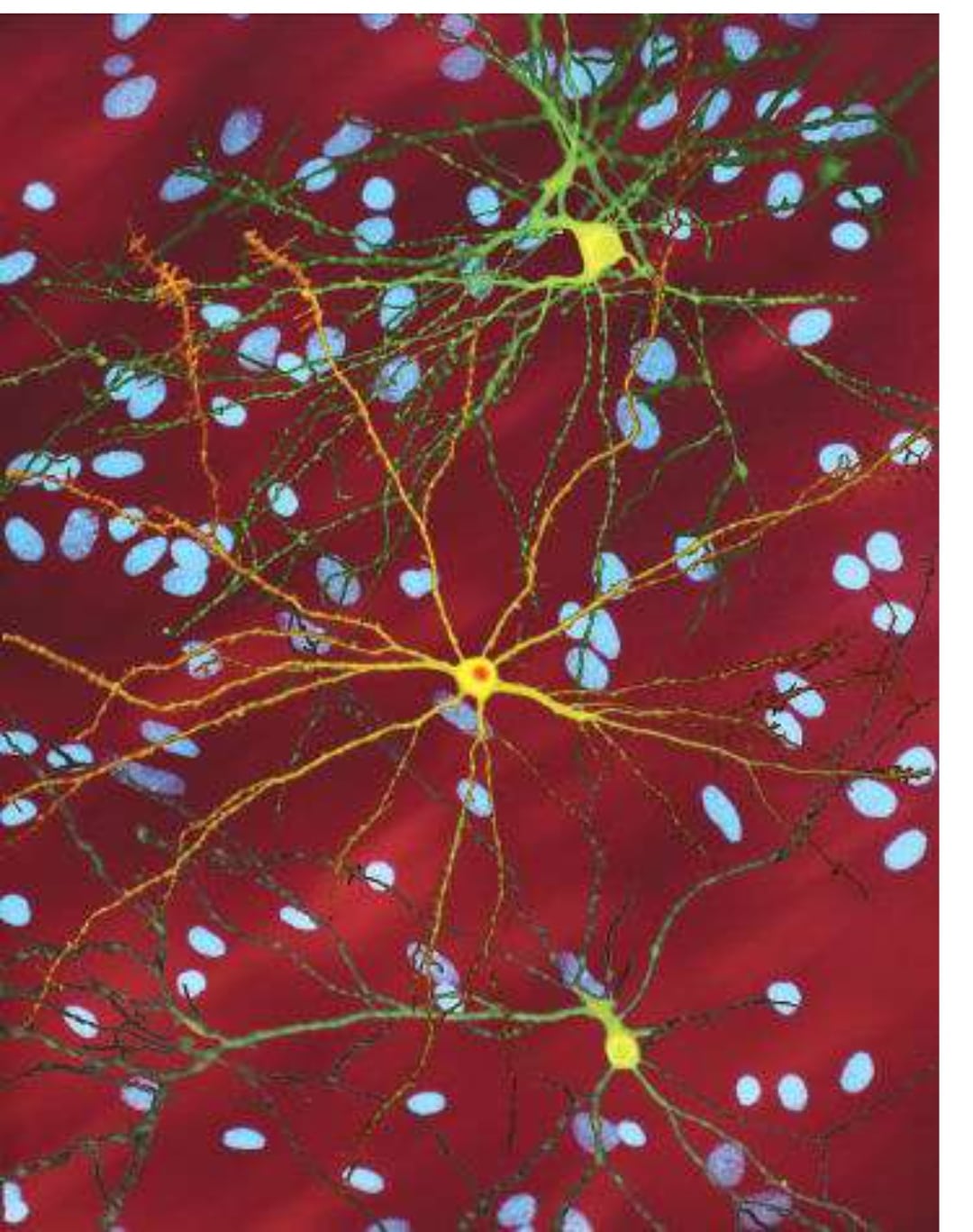 Sla, alzheimer, organoidi cerebrali