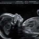 Ecografia prenatale di routine identifica i primi segnali di asd %ecografia prenatale di routine identifica i primi segnali di asdcount(title)% Ecografia prenatale di routine identifica i primi segnali di asd