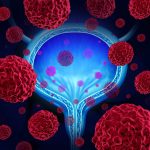 Carcinoma ovarico sieroso: la salpingectomia opportunistica ne abbatte l'incidenza dell'80% %carcinoma ovarico sieroso: la salpingectomia opportunistica ne abbatte l'incidenza dell'80%count(title)% Carcinoma ovarico sieroso: la salpingectomia opportunistica ne abbatte l'incidenza dell'80%