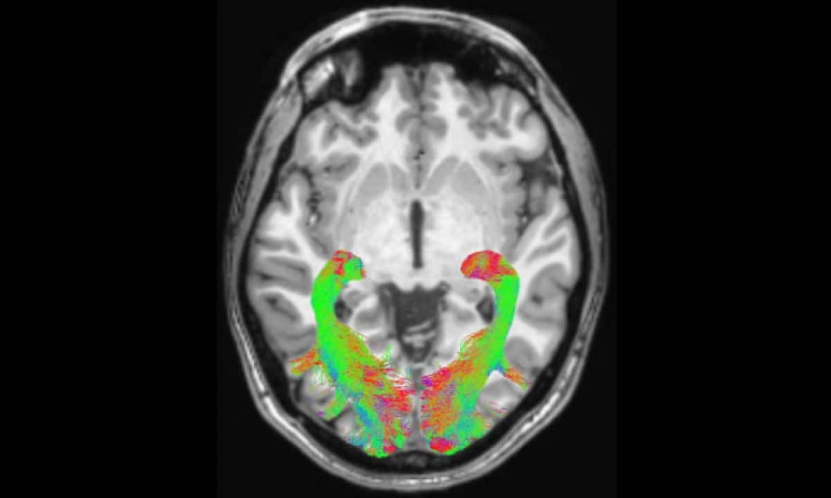 Parkinson, sarm1