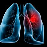 Cancro al polmone: individuata proteina che ne regola lo sviluppo %cancro al polmone: individuata proteina che ne regola lo sviluppocount(title)% Cancro al polmone: individuata proteina che ne regola lo sviluppo