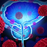 Metastasi del cancro alla prostata: scoperta la causa