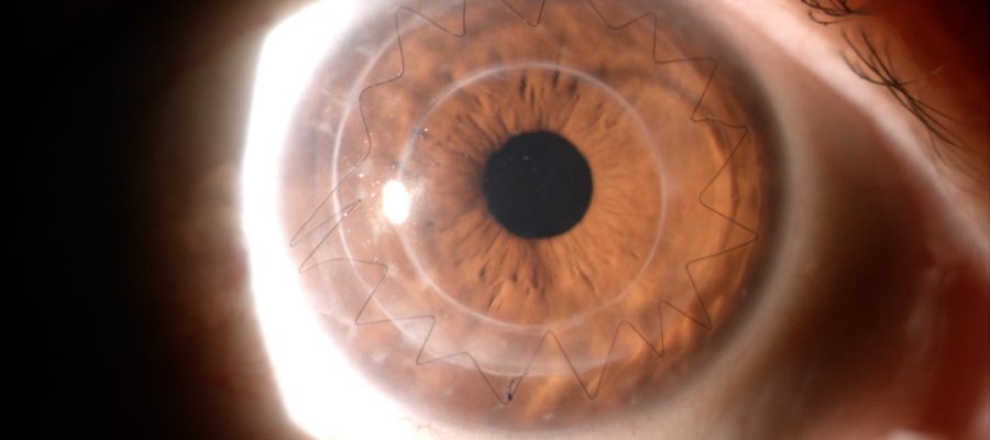 Cerotto con cellule staminali retiniche 