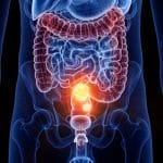Emodin: previene il cancro al colon nei topi