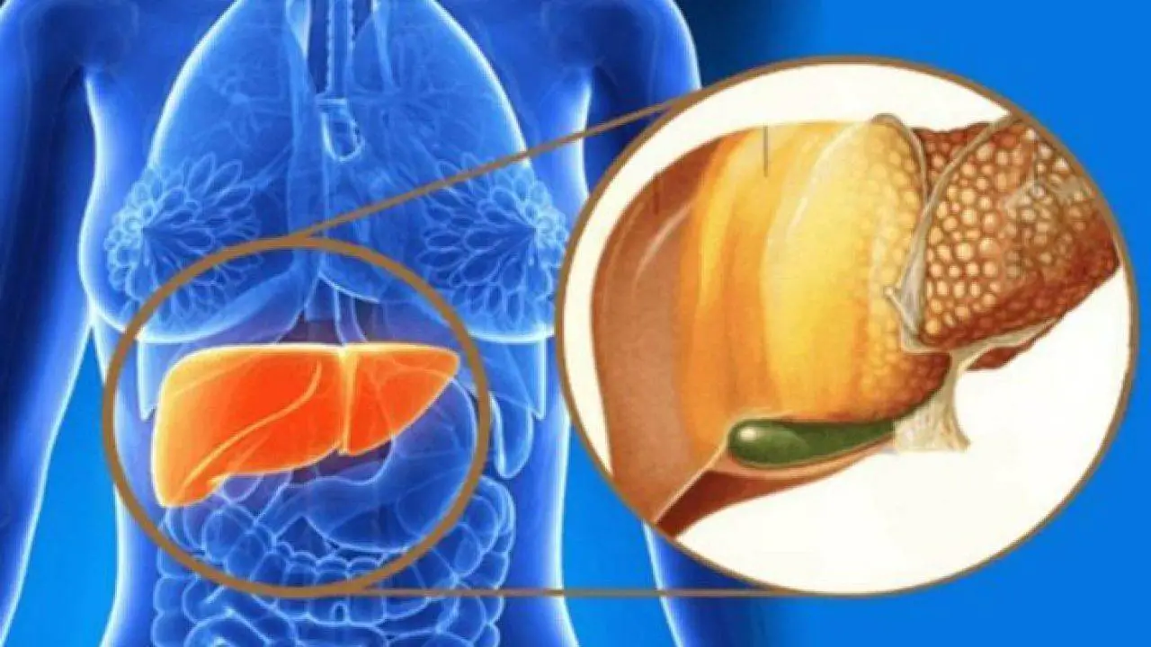 Nafld, cancro al fegato