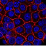 Adenocarcinoma duttale pancreatico: l'a. I. Ne predice l'esordio %adenocarcinoma duttale pancreatico: l'a. I. Ne predice l'esordiocount(title)% Adenocarcinoma duttale pancreatico: l'a. I. Ne predice l'esordio