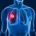 Tumore al polmone: il vaccino ccl21 con pembrolizumab funziona?