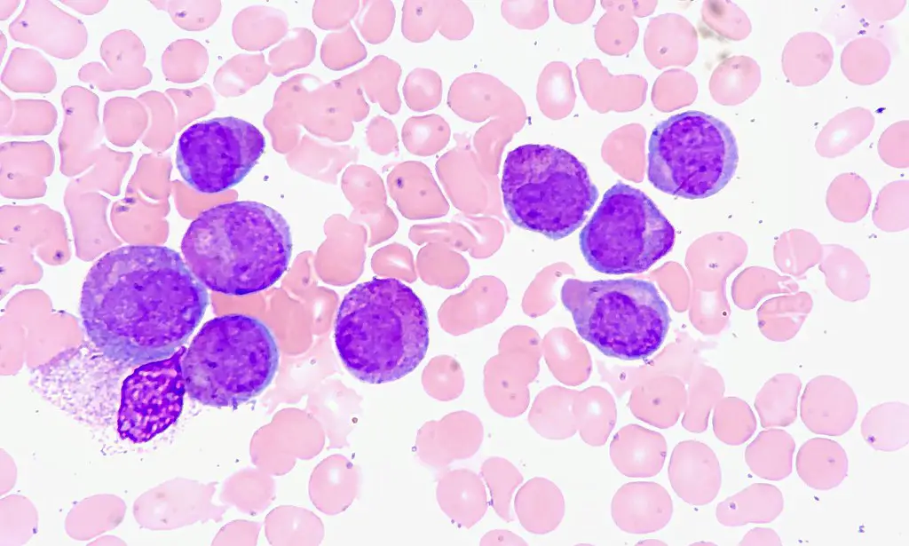 Leucemia Promielocitica Acuta Trovato Target Terapeutico