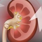 Calcoli renali: più face rimuoverli con l'idrogel