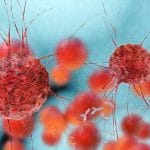 Car-t: come superare la resistenza dei tumori solidi
