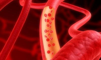 Hypertrophic cardiomyopathy