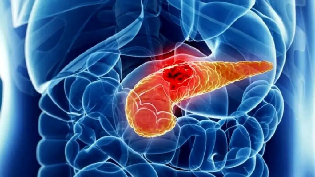 adenocarcinoma duttale pancreatico