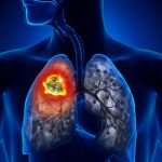 Cancro al polmone: scoperte 14 proteine nel sangue che svelano il tumore in anticipo
