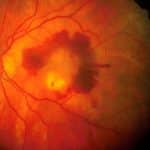 Degenerazione maculare (amd): identificati i primi segni della malattia %degenerazione maculare (amd): identificati i primi segni della malattiacount(title)% Degenerazione maculare (amd): identificati i primi segni della malattia