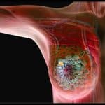 Nanomedicina mirata ai linfonodi chiave per la terapia al cancro al seno triplo negativo %nanomedicina mirata ai linfonodi chiave per la terapia al cancro al seno triplo negativocount(title)% Nanomedicina mirata ai linfonodi chiave per la terapia al cancro al seno triplo negativo