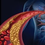 Ipercolesterolemia familiare: test genetici potrebbero identificarla %ipercolesterolemia familiare: test genetici potrebbero identificarlacount(title)% Ipercolesterolemia familiare: test genetici potrebbero identificarla