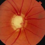 Lente a contatto somministra le terapie per il glaucoma %lente a contatto somministra le terapie per il glaucomacount(title)% Lente a contatto somministra le terapie per il glaucoma