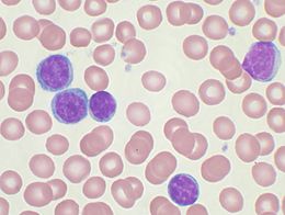 Leucemia linfocitica cronica 