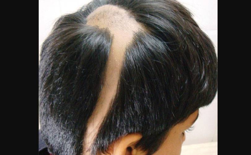 Alopecia areata