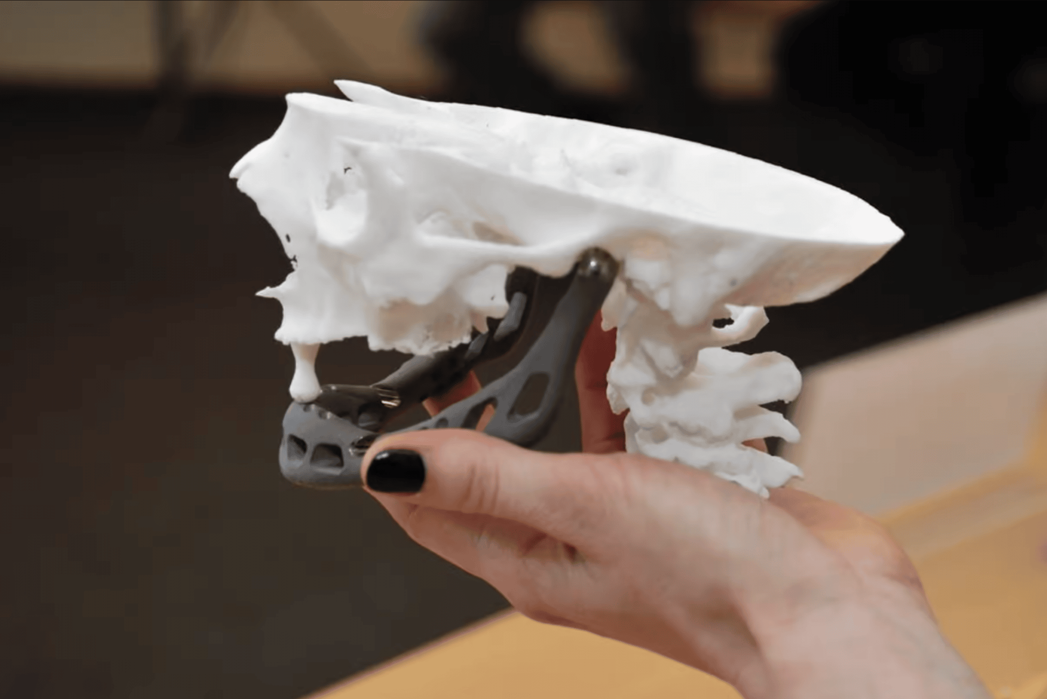 Prima mascella in titanio stampata in 3D