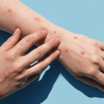 Monkeypox 2022: il virus si diffonde in via asintomatica?