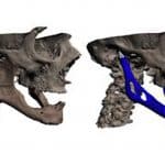Prima mascella in titanio stampata in 3d al mondo, è realtà