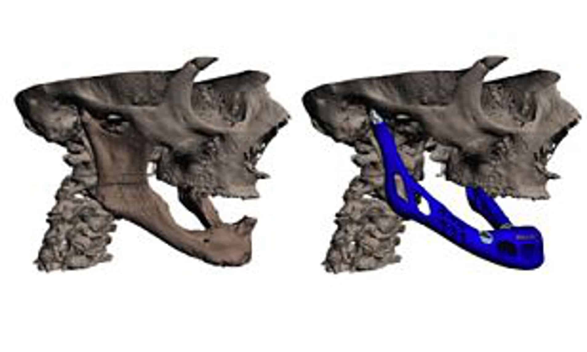 Prima mascella in titanio stampata in 3d