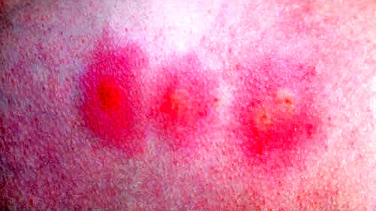 Influenza