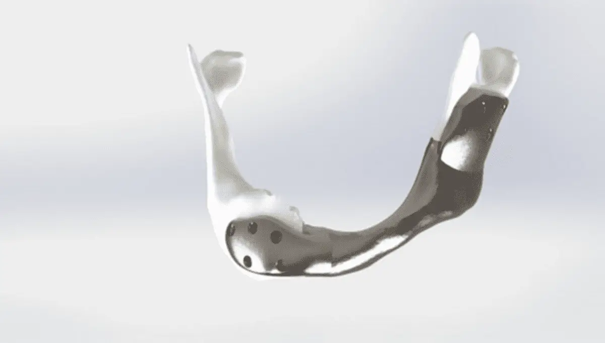 Prima mascella in titanio stampata in 3D