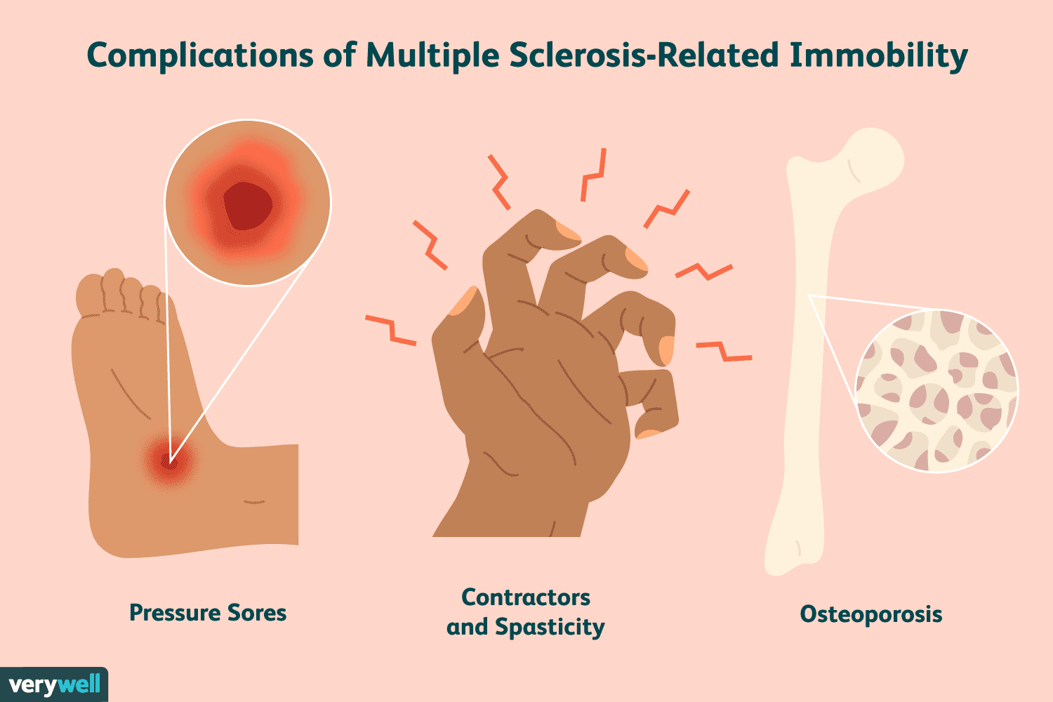 sclerosi multipla