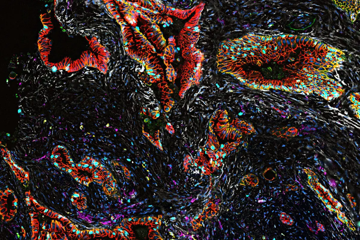 Cancro al pancreas