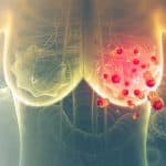 Biomarcatore tms: l'evoluzione computazionale nella lotta al tumore triplo negativo