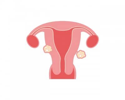 Fibromi uterini