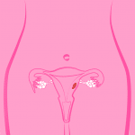 Fibromi uterini