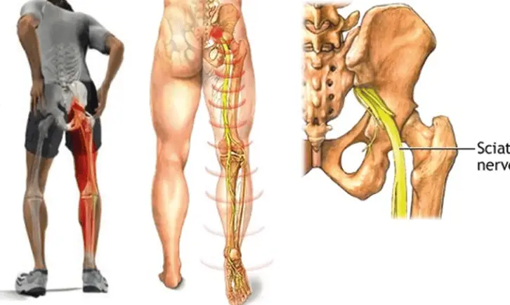 Sciatica