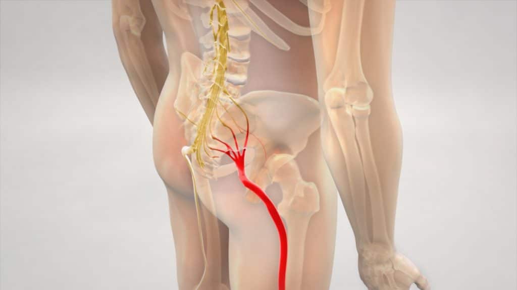 Sciatica