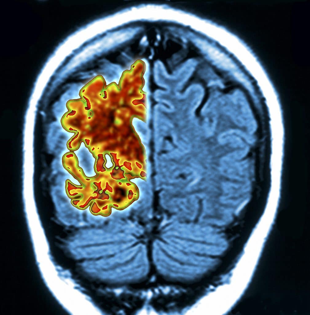 lecanemab, Alzheimer