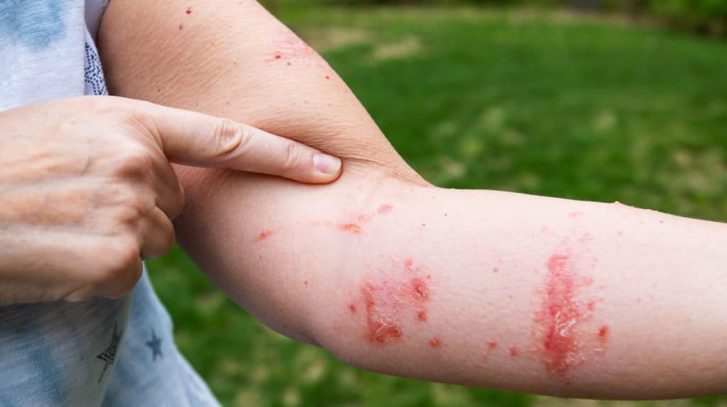Dermatite atopica: top 5 delle terapie più innovative %dermatite atopica: top 5 delle terapie più innovativecount(title)% Dermatite atopica: top 5 delle terapie più innovative
