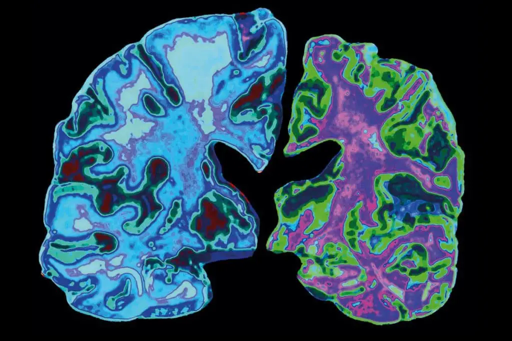 Lecanemab, Alzheimer's